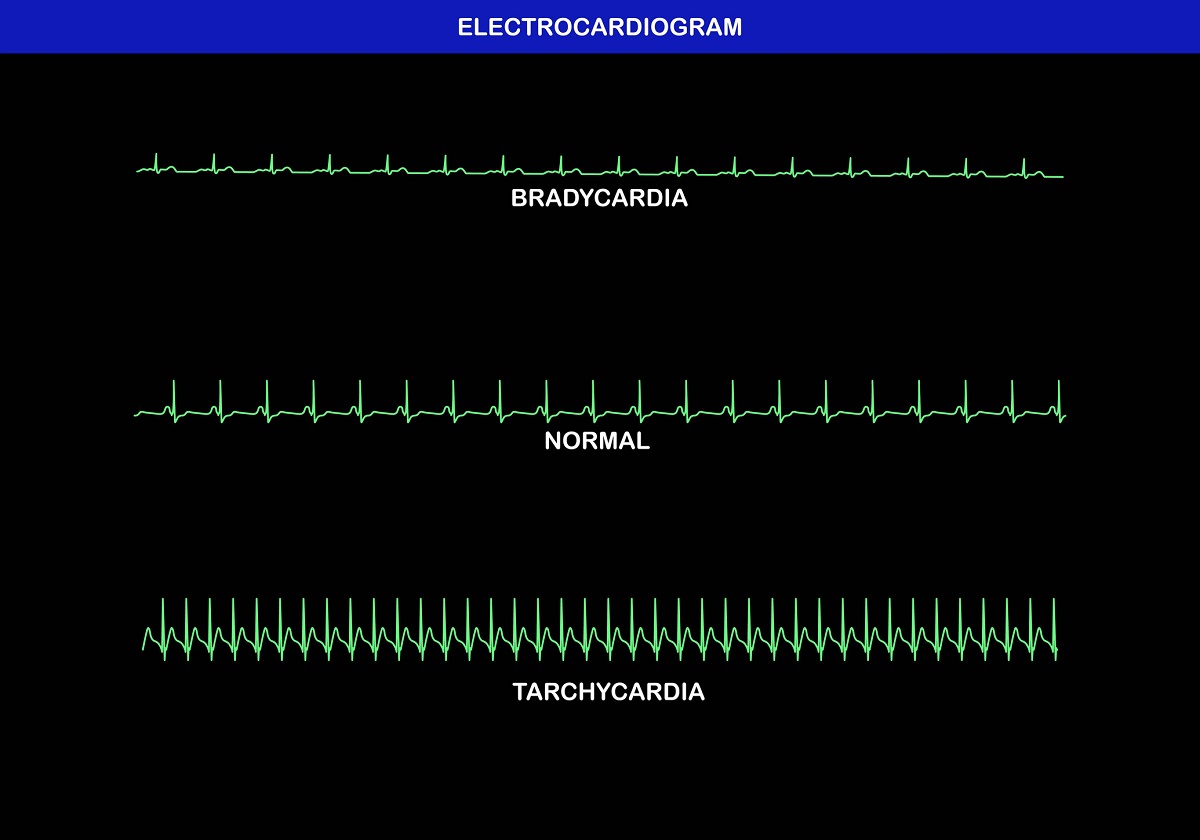 Fyziologický, zrýchlený a spomalený tep na EKG - EKG krivka